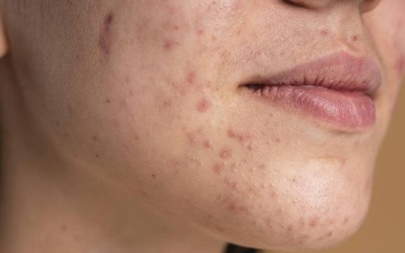 Cinco remedios caseros para combatir el acné