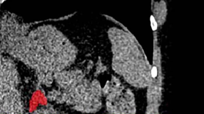 Gracias a un modelo de inteligencia artificial, investigadores han identificado un nuevo biomarcador visible en imágenes médicas de rutina que permite detectar el estrés crónico. Foto: Elena Ghotbi.