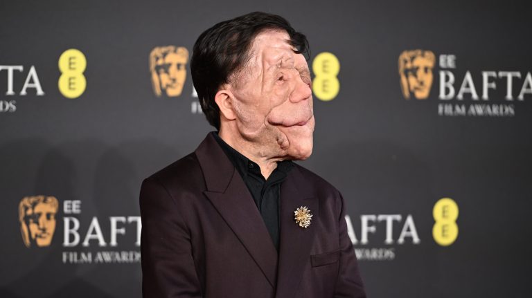 ¿Qué es la neurofibromatosis, condición que padece el actor Adam Pearson?